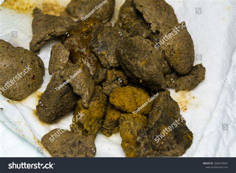 poop with impacted feces